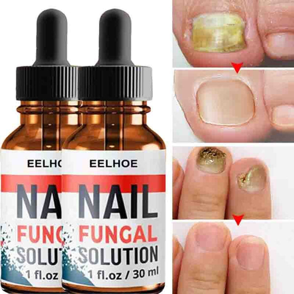 Nail Repair Serum Nail Fungal Treatment Serum Onychomycosis Paronychia