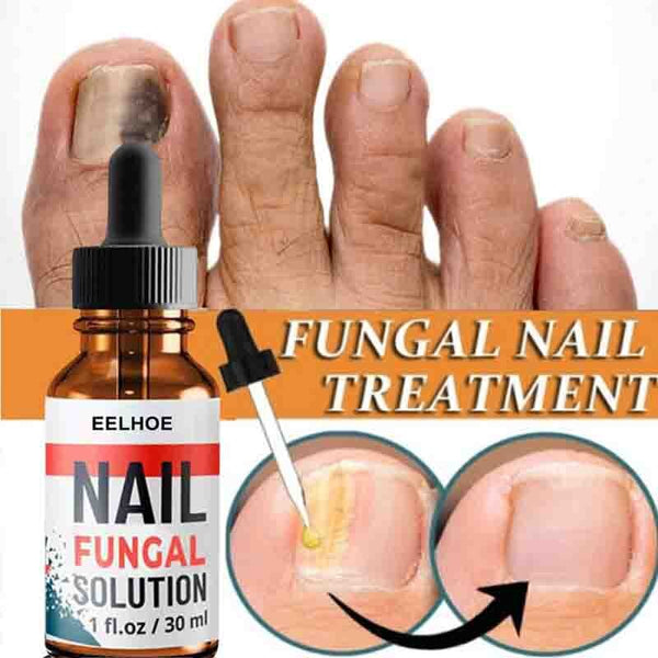 Nail Repair Serum Nail Fungal Treatment Serum Onychomycosis Paronychia